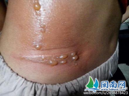 小妮腰部被面烫伤起泡